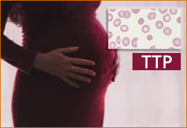 CASE REPORT: Postpartum TTP (773)