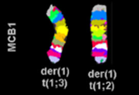 CASE STUDY: New AML with Complex Karyotype (788)