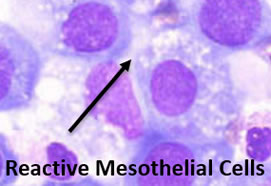 Body Fluid Effusions: Identifying Benign vs Malignant Cells (794)