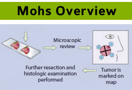 Mohs Surgery Overview (820)