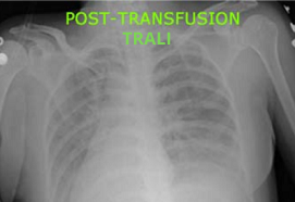 Risks, Complications, and Reactions Associated with Transfusions (828)