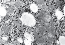 Electron Microscopy of Liver Biopsies (839)