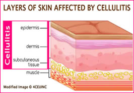 Infectious Complications Caused by Phlebotomy (857)